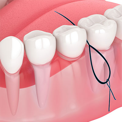 floss-threader-suitable3