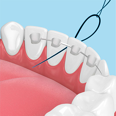 floss-threader-suitable4